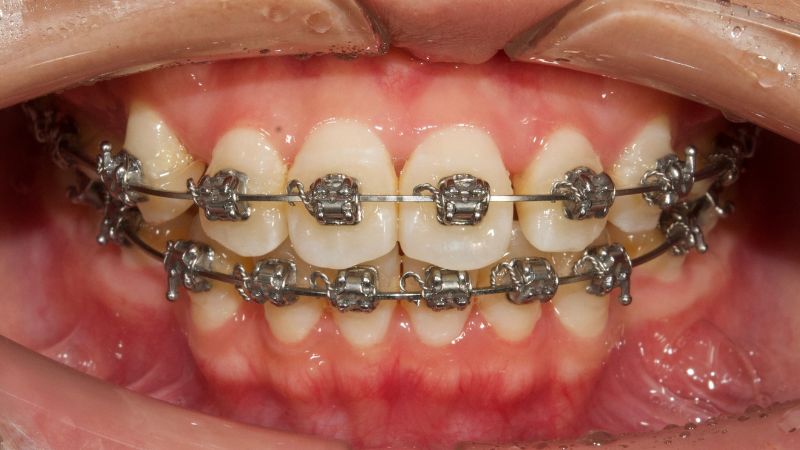 Hình ảnh quy trình niềng răng tại phòng khám Nhi Nguyễn