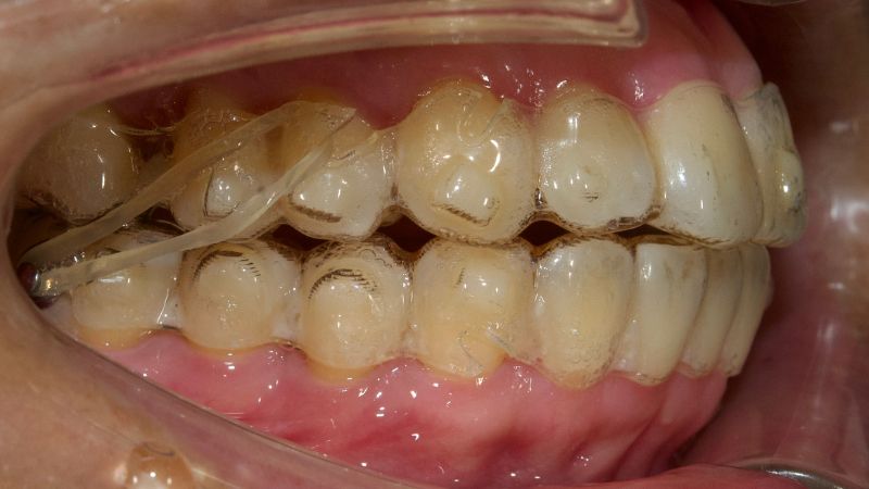 Niềng răng trong suốt