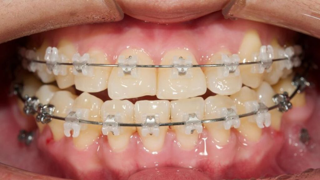 Mắc cài sứ tự buộc