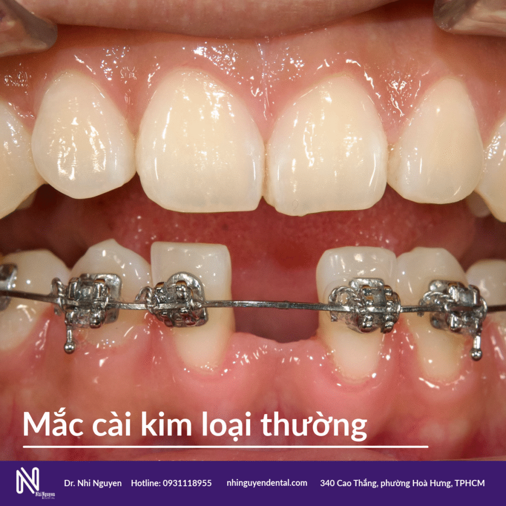mac cai kim loai thuong