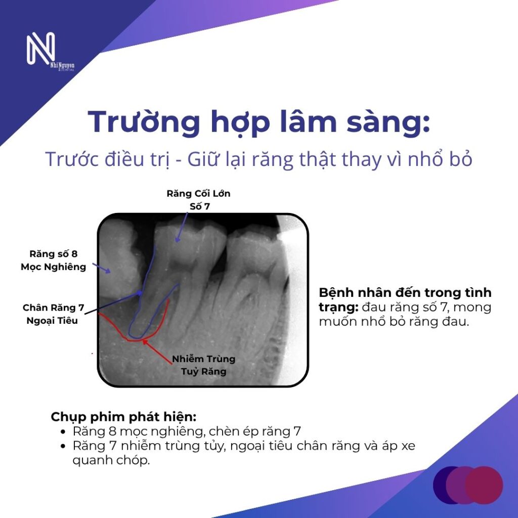 nho rang nhanh gon co tot hon lay tuy