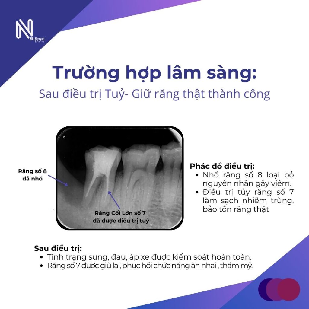 nho rang nhanh gon co tot hon lay tuy