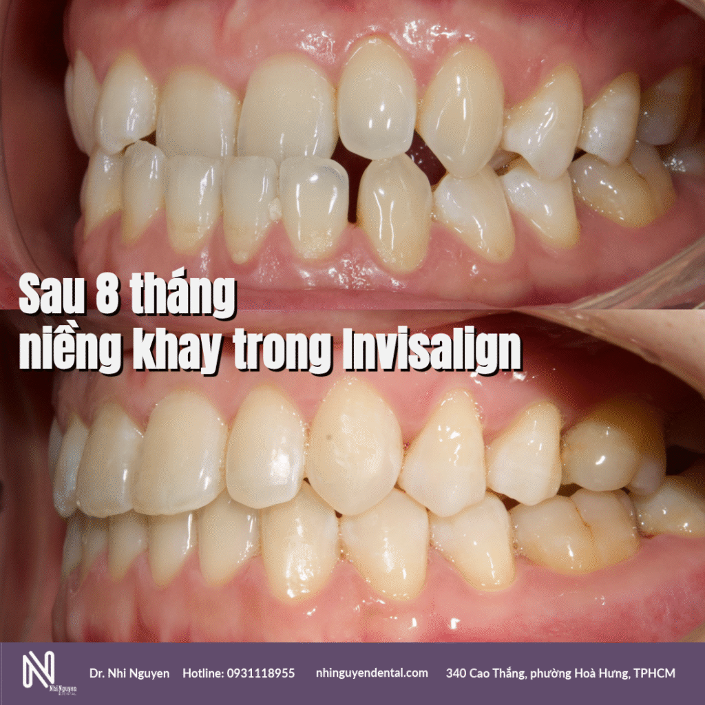 nieng rang khong nho rang bang khay trong suot