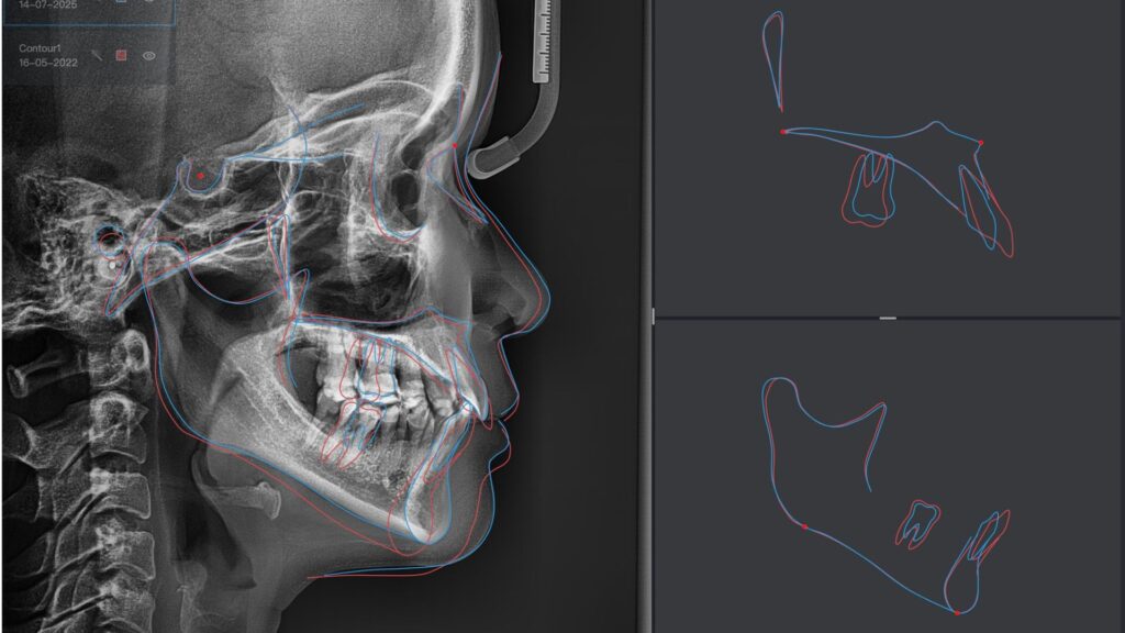 Len ke hoach nieng rang bang phan mem phan tich phim va du doan ket qua sau dieu tri