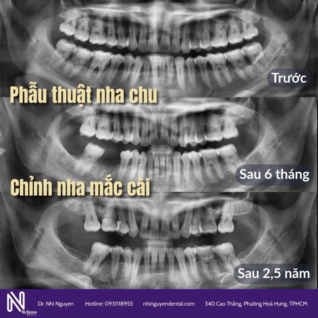 dieu trị nha chu truoc khi nieng rang
