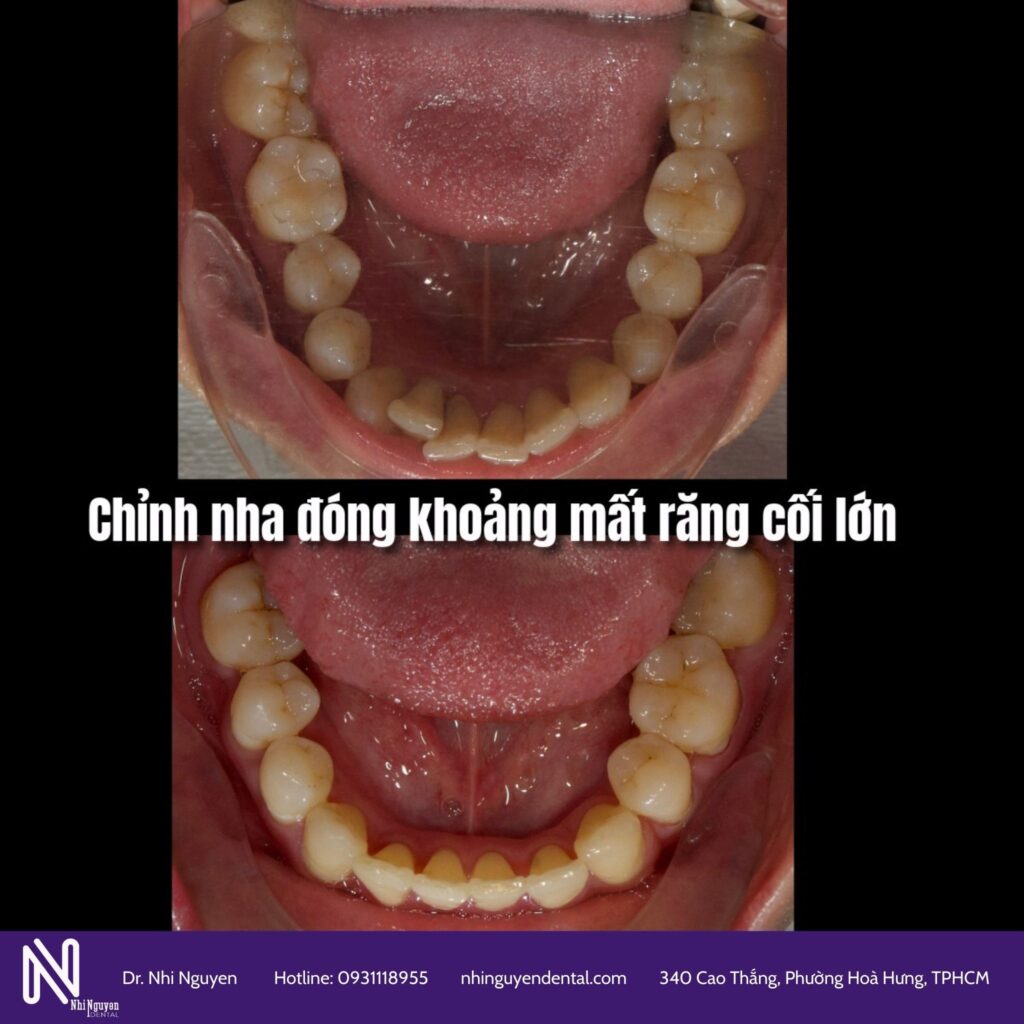 Nieng rang dong khoang mat rang coi