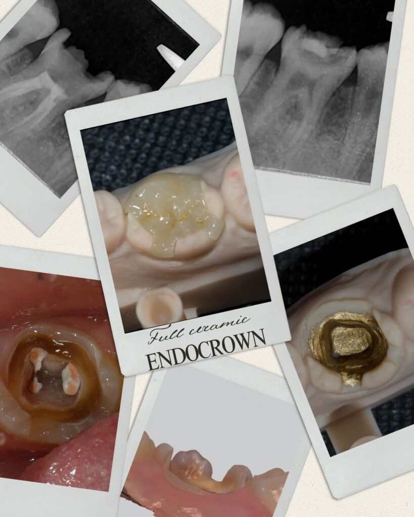 so sanh boc su sau lay tuy