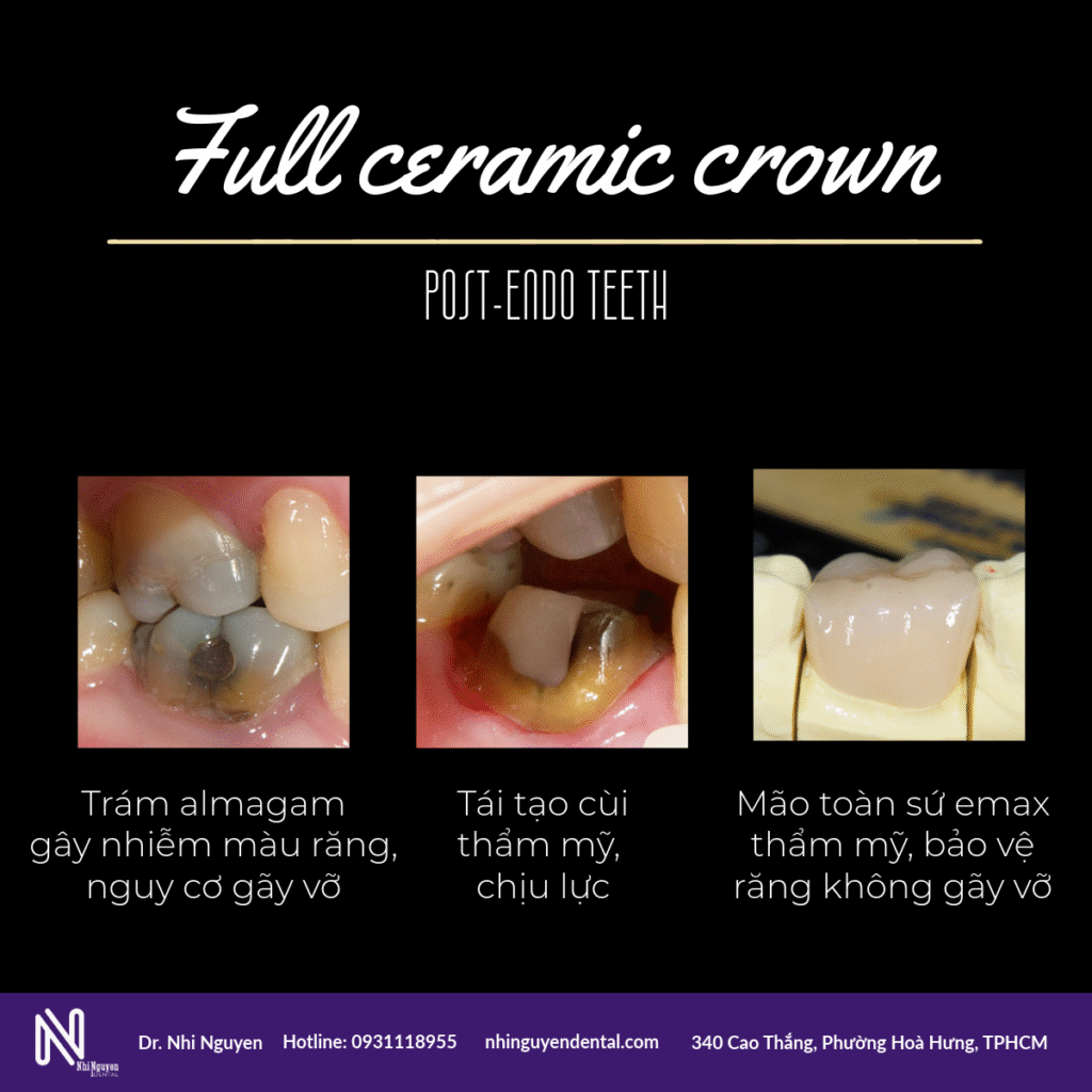 boc mao su sau lay tuy