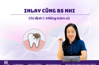 Inlay thay miếng trám cũ