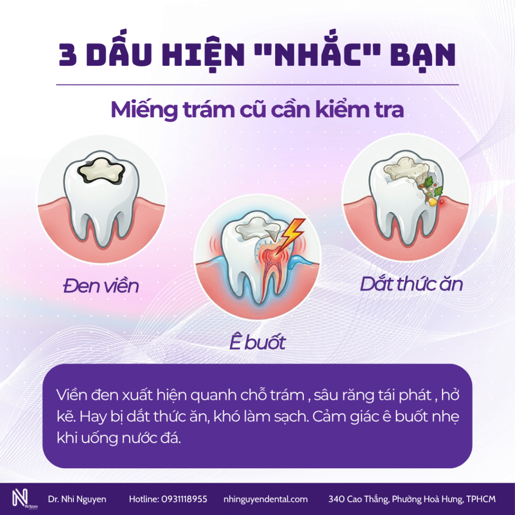 Dấu hiệu miếng trám cũ cần thay