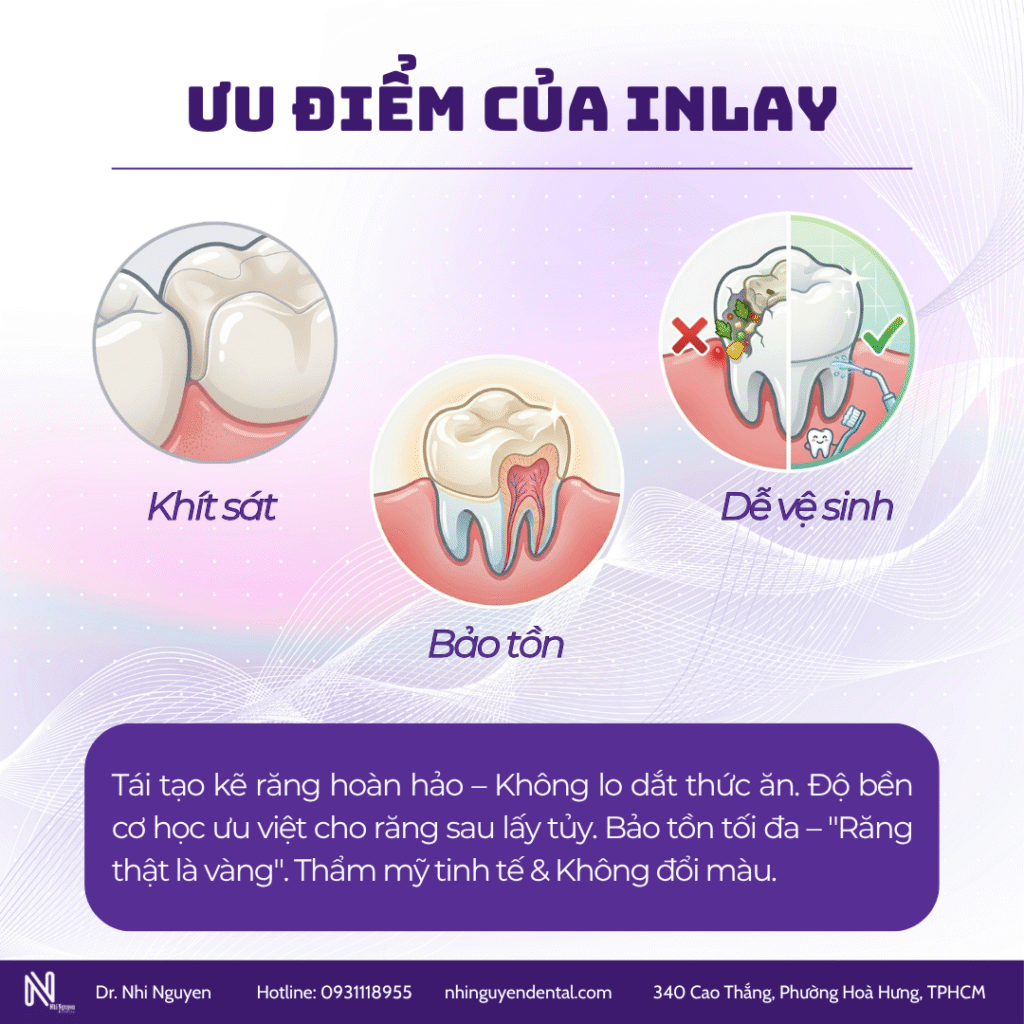 Ưu điểm của inlay