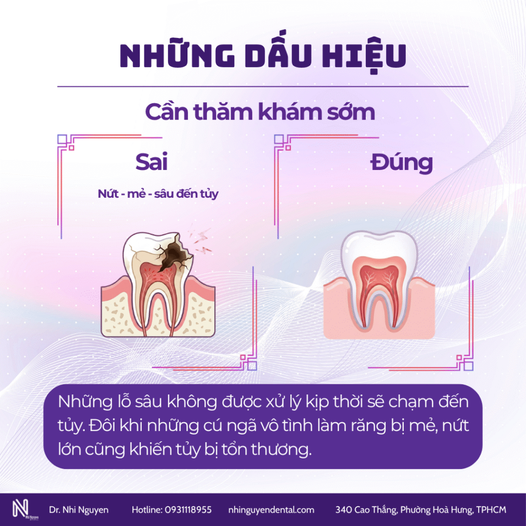 Chữa tuỷ răng sữa chấn thương