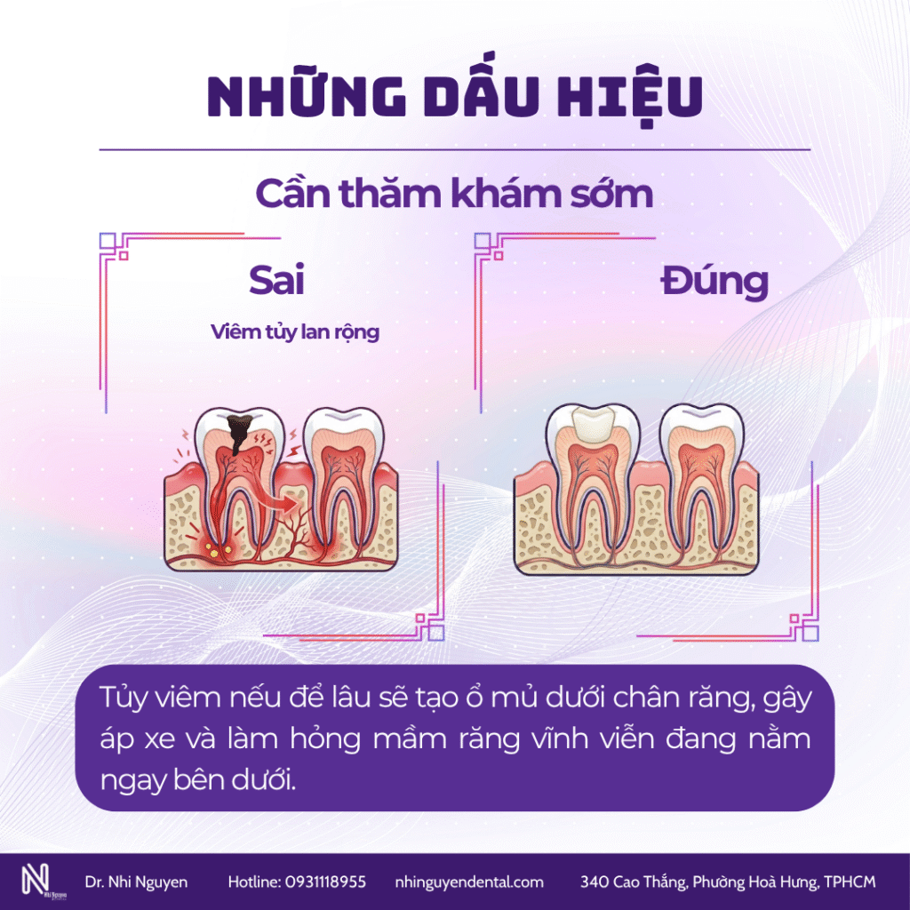 Chữa tuỷ răng sữa bị viêm