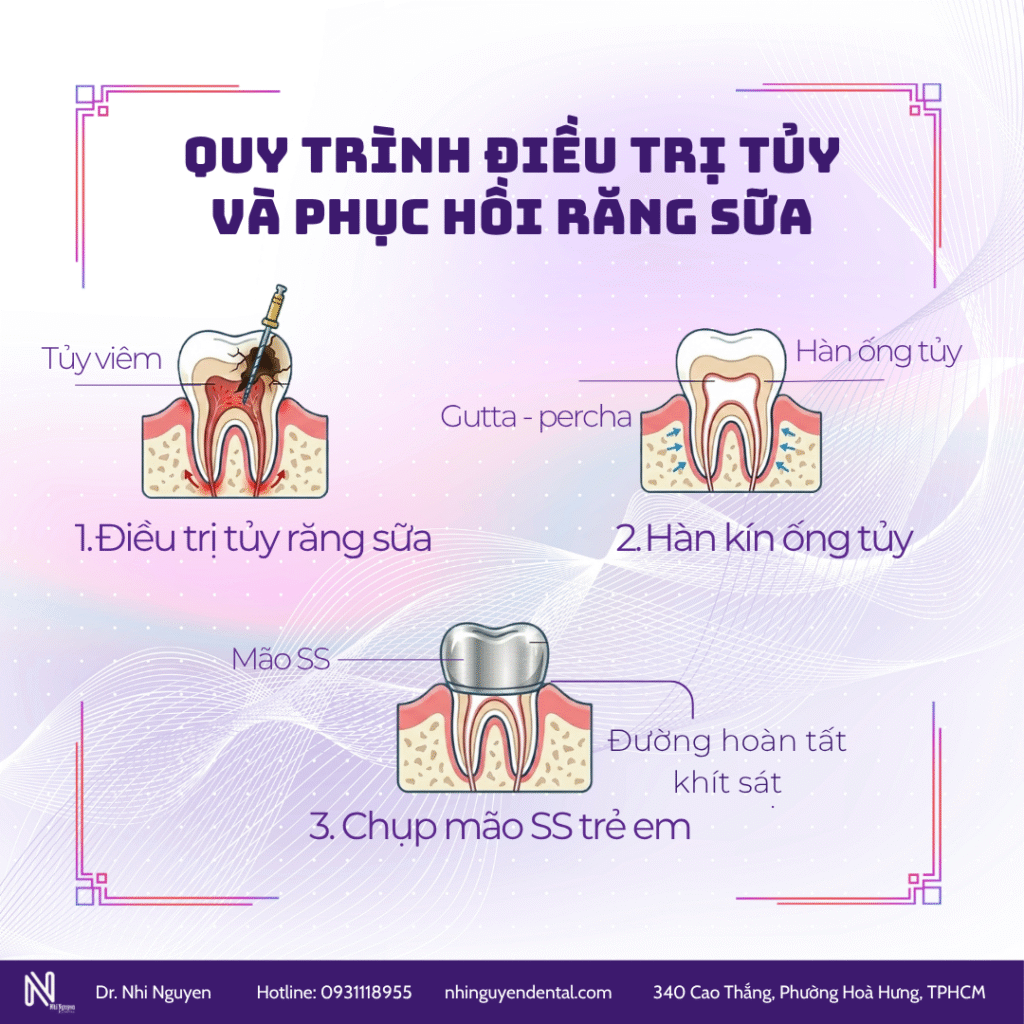 Quy trình chữa tuỷ răng sữa
