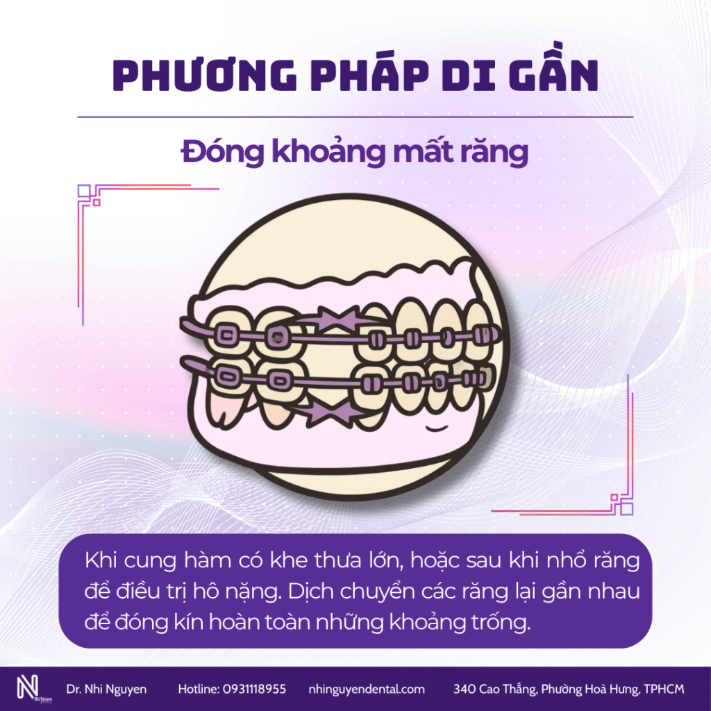 Di gần đóng khoảng mất răng