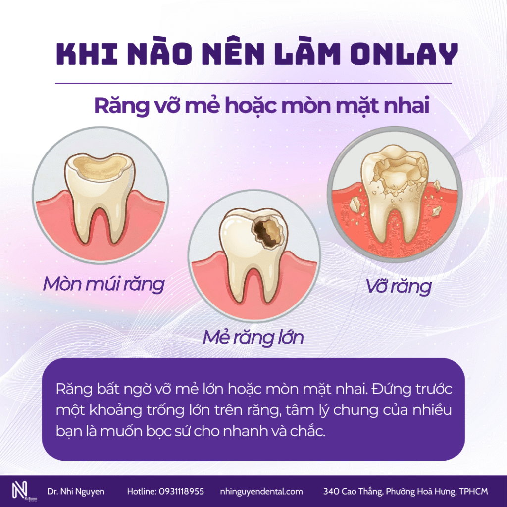 Khi nào nên làm onlay