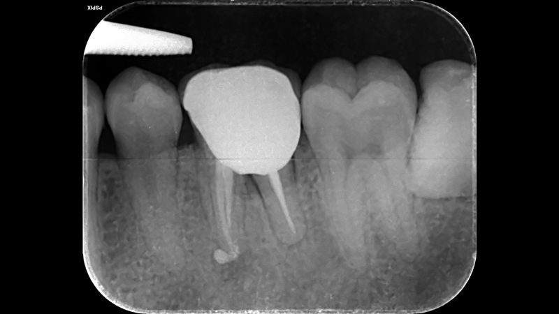 Lấy tủy không đau