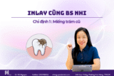 Bật mí 3 trường hợp nên chọn giải pháp inlay thay miếng trám cũ để bảo vệ răng thật
