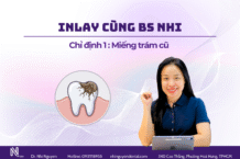 Bật mí 3 trường hợp nên chọn giải pháp inlay thay miếng trám cũ để bảo vệ răng thật