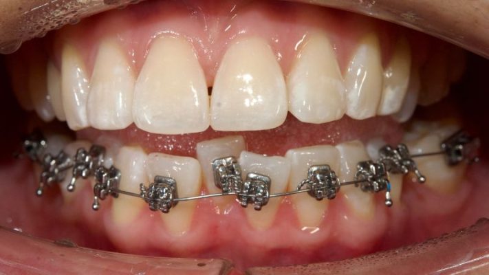 Răng chen chúc mắc cài kim loại