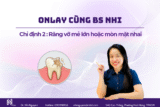 Khám phá 3 lý do nên ưu tiên giải pháp onlay cho răng mẻ miếng lớn thay vì bọc sứ