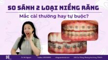So sánh 2 loại niềng răng mắc cài: Thường hay tự buộc?