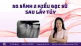 So sánh 2 kiểu bọc sứ sau lấy tuỷ: Mão và Endocrown